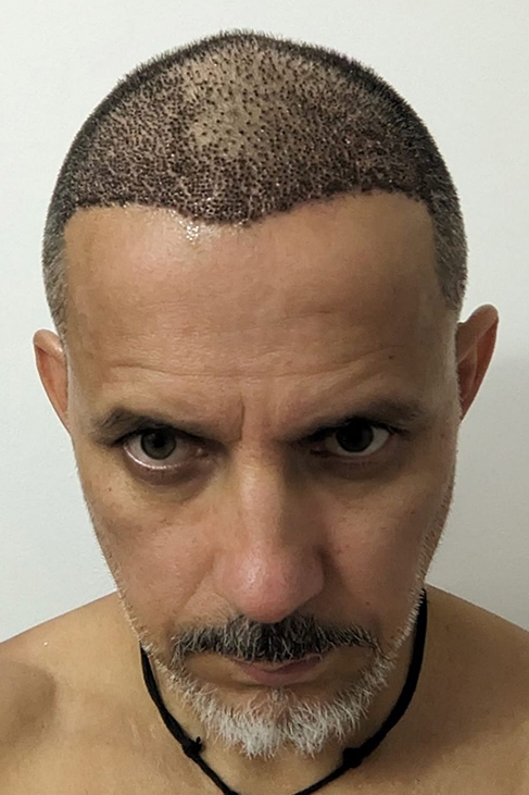 Early healing stage 1 week after hairline transplant demonstrating graft placement