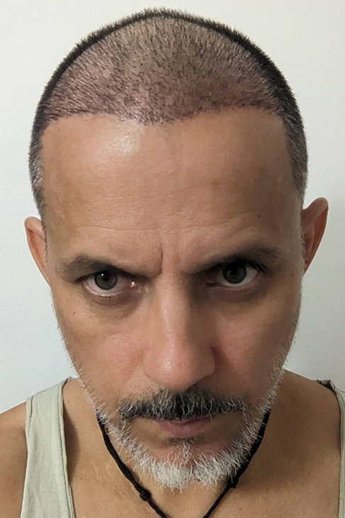 Hairline transplant progress showing developing frontal density after 2 weeks and natural hairline transition