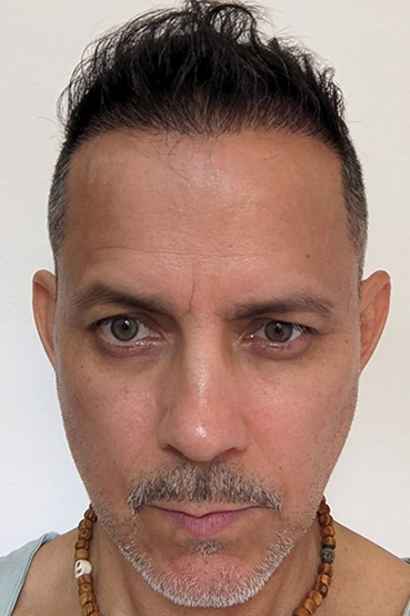 Final hairline transplant after 7 months result showing natural frontal hairline restoration and improved facial balance