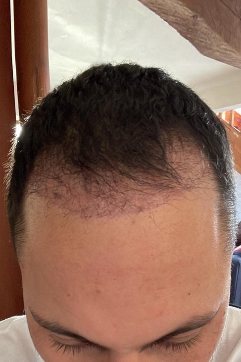 One month after hairline transplant during early regrowth phase