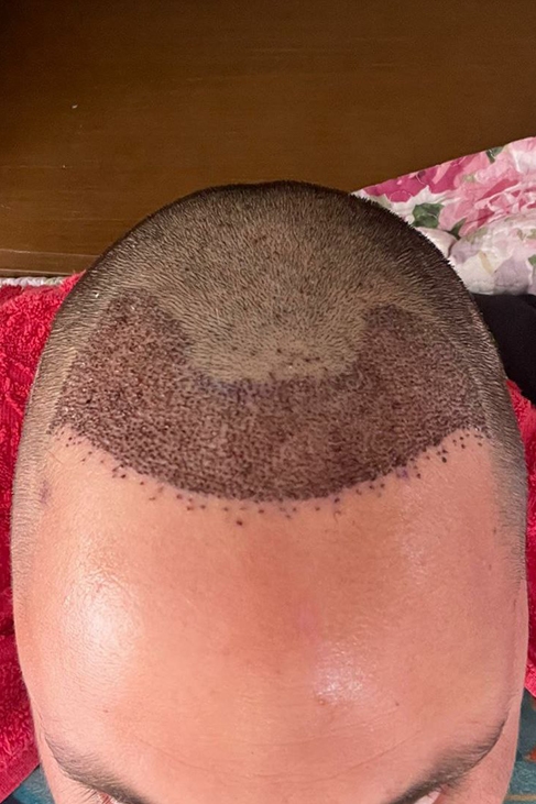 One week after hairline transplant showing healing grafts and early recovery