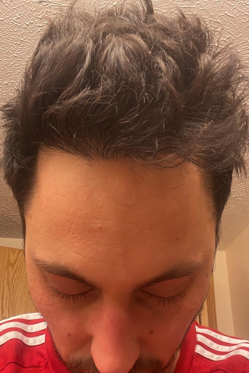 One year after hairline transplant showing final natural density
