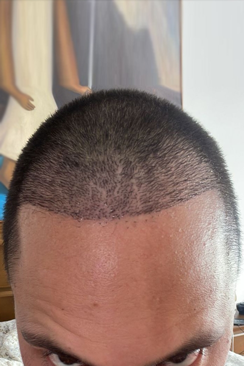 Two weeks after hairline transplant during early recovery phase