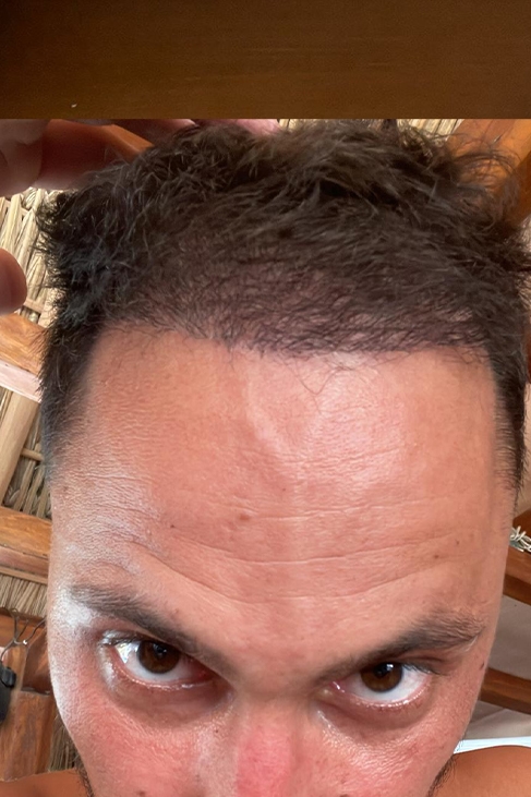 Four months after hairline transplant showing visible new growth