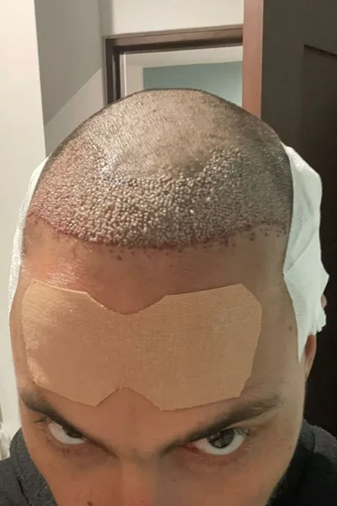 Day 1 after hairline transplant with visible graft placement and early healing